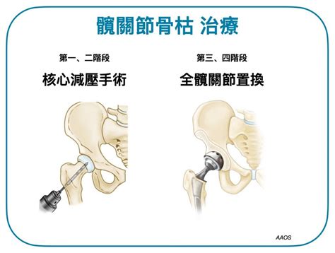 骨枯手術費用|髖關節骨枯：成因與治療